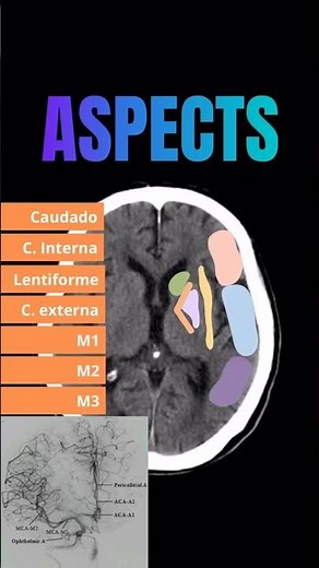 ASPECTS SCORE to assess ischemic stroke 🖤