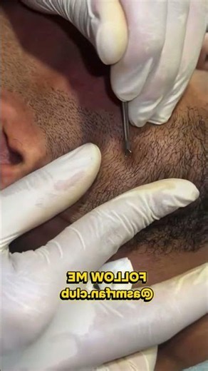 Masive Blackhead Finally Comes Out After Years