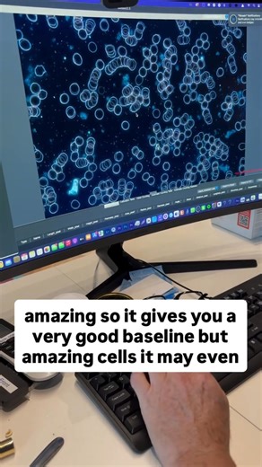 ⚡️This is what EMFs do to blood 🩸 👉 First clip: near-perfect blood, red cells flowing freely.�👉 Second clip: just 15 minutes of EMF exposure (3 phones around me)… blood cells clumped together, sticky, inflamed.�👉 Third clip: after red light therapy, vibration plate, nebuliser, grounding and sunlight… back to almost normal. There was more to be done. We are electrical ⚡️ beings. �Excess EMFs can literally disturb the voltage in our cells. Non-native EMFs create distortion. �The good news is t