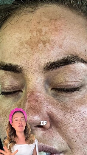 281 reactions · 8 comments | ✨ Dark spots & melasma ✨ad I sometimes...