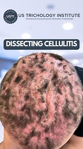 Dissecting Cellulitis, The Intricacies of Skin Inflammation . . . #HairLoss #Alopecia #HairTransplant #HairGrowth #ThinningHair #HairRestoration #Baldness #HairLossTreatment #HairLossSolutions #Balding | United States Trichology Institute | Facebook