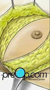 PreOp® Total Mastectomy: A Patient’s Guide to Surgery 🏥📖 #preop #shorts #health 📋