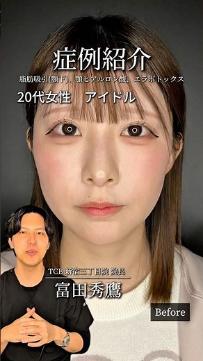 【脂肪吸引】アイドルの小顔整形を徹底解説します#shorts