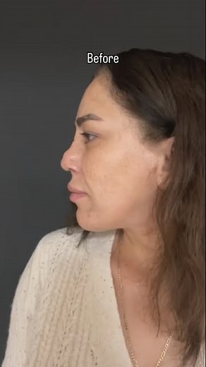 Sercan Gode | CONTRACTED SKIN! 5th rib revision rhinoplasty with patients own rib cartilage in closed approach, cast off day 6 days postop | Instagram