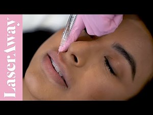 Lips By LaserAway | Juvederm | Ask Dr. Kirby