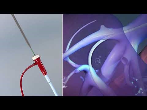 Viatorr - Gore Medical