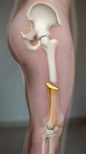 Understanding Bone Fractures Through 3D Animation