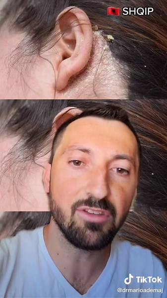 Psoriasis vs Seborrheic Dermatitis: Key Differences Explained