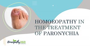 Homoeopathy in The Treatment of Paronychia - homeopathy360