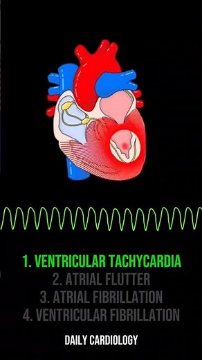 ECG Rhythms (Ventricular Tachycardia, Atrial Flutter, Atrial Fibrillation, Ventricular Fibrillation)