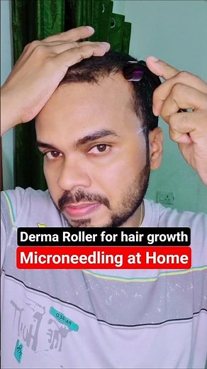 Derma roller for hair growth | Microneedling at home #hairloss #dermaroller #hairregrowth #shorts