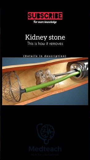 How to cure kidney stones.! ‼️ #youtubeshorts #healthshorts