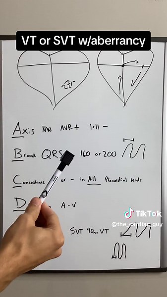 How to discern between SVT and VT? #svt #vt #ecg #ekg #ecginterpretation #nursingstudent #nurse #fyp