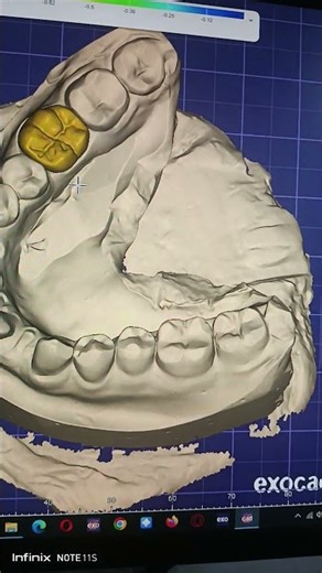 #exocad #anatomy #dentist