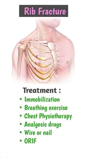 Rib Fracture & their Treatment 🫵💊| #shorts