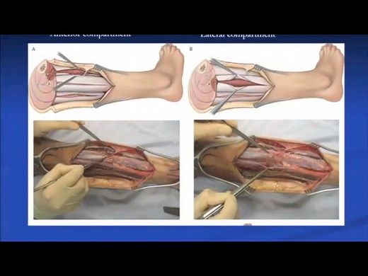 Single Incision Four Compartment Parafibular Fasciotomy - Robert Ostrum, MD