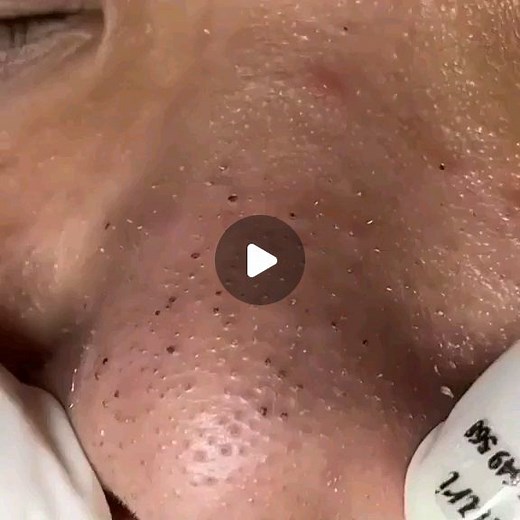 Big Cyst on Instagram: "Follow us 👉 @pimplepopper2023 for more pimple popping videos . **Please we need your help to stay in this social network. Say something about our post and tag a friend. or we'll completely desappear from your nev feed. Appreciate your help. . . #pores #acne #skincare #blackheads #pimples #whiteheads #pimple #blackhead #skin #beauty #blackheadextraction #blackheadremoval #pimplepopping #whitehead #pimplepop #pimplepoppers"