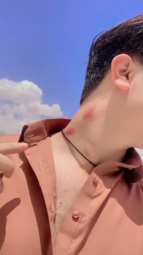 Identifying Skin Reactions: Red Marks on Neck