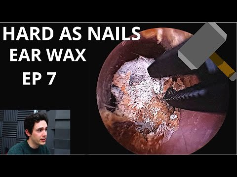 Hard As Nails Ear Wax EPISODE 7