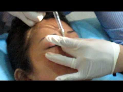 Fillers injection for sharper nose bridge