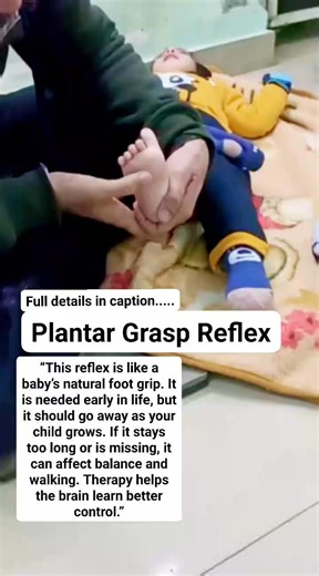 “Tiny Toes, Big Impact! 👣 Understanding the Plantar Grasp Reflex” Plantar Grasp Reflex 👣 ✅What is the plantar grasp reflex? When a baby is born, their body has some automatic movements called primitive reflexes. The plantar grasp reflex is one of them. When we gently press the sole of a baby’s foot (just under the toes), the baby’s toes curl or grip the finger. 👉This reflex is normal and healthy in babies. ______________________________________________ ✅Why is this reflex important? This refl