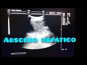 ULTRASOUND OF AN AMOEBIAN LIVER ABSCESS, ULTRASOUND OF LIVER ABSCESS, LIVER ABSCESS