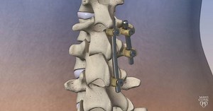 97K views · 127 reactions | Minimally invasive spine surgery, when necessary, helps patients recover faster. https://mayocl.in/2Ytidt9 | Mayo Clinic | Facebook