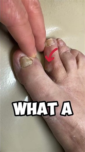 Curiosity Unleashed: What Does Corn on a Toe Look Like?