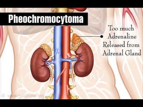 Pheochromocytoma: Symptoms, Pathophysiology, Diagnosis and Treatment