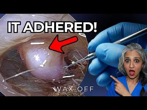 Colossal Ear Polyp Tangled In Earwax Removal | Expert Audiologist | Wax Off Episode 69