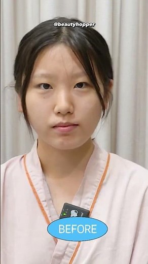 plastic surgery before and after in korea 😍