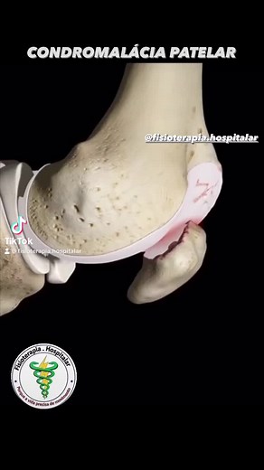 Condromalácia Patelar: Causas, Sintomas e Tratamento