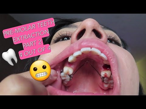 🦷💕 Pre-molar Teeth Extraction 💕🦷 | Part 2 | 4 out of 4 | Adult Braces Journey | Vlog 13