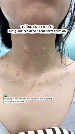 Trứng cá do thuốc: Nguyên nhân, dấu hiệu và cách phòng ngừa