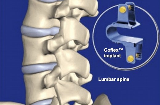 CoFlex Surgery - Florida Surgery Consultants