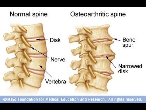 Anatomy of Spinal Arthritis Explained by Top Pain Doctor in Las Vegas, Nevada