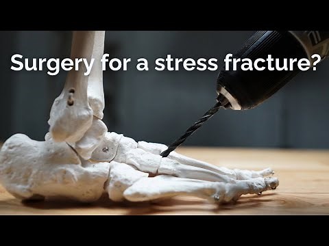 Stress Fracture Surgery: Locations, Risks, & Outcomes
