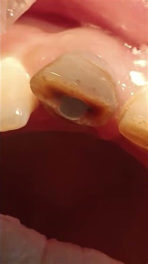 root canal treatment #dentalprosthesis