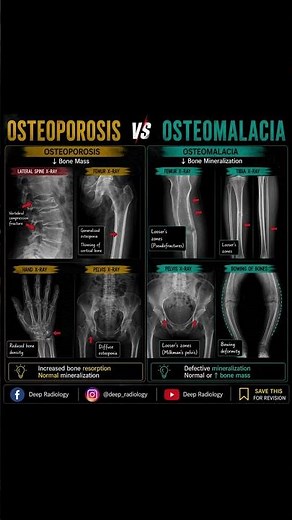 Osteoporosis vs Osteomalacia X-ray Difference