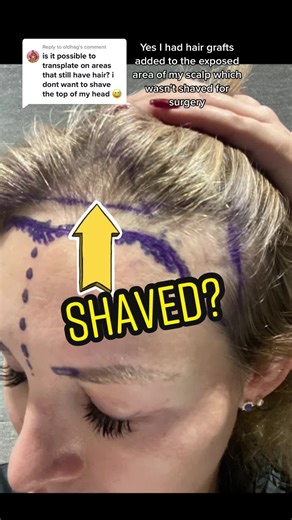Female Hair Transplant: Before & After