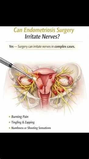 Can Endometriosis Surgery Irritate Nerves? #fypviral #iam1in10🎗️ #k_endowarrioronig