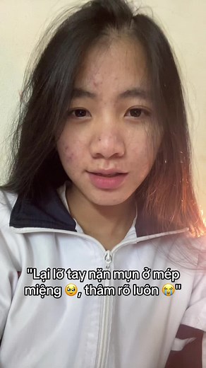 Nặn Mụn Ở Mép Miệng: Ảnh Hưởng và Cách Giải Quyết