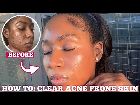 HOW I CLEARED MY ACNE SCARS & HYPERPIGMENTATION *FOR GOOD* IN ONE MONTH | 3 STEPS FOR FLAWLESS SKIN