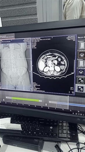 Ct enterography //Small intestine scan #ctscan