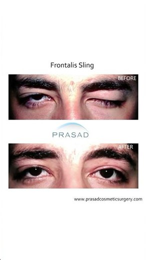 Droopy Eyelids Blocking Vision? The Solutions #ptosis