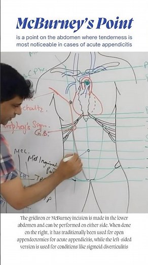 McBurney's Point, McBurney incision #shorts