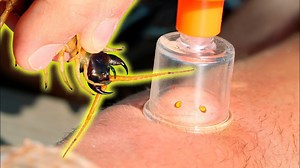Venom extraction after a centipede bite