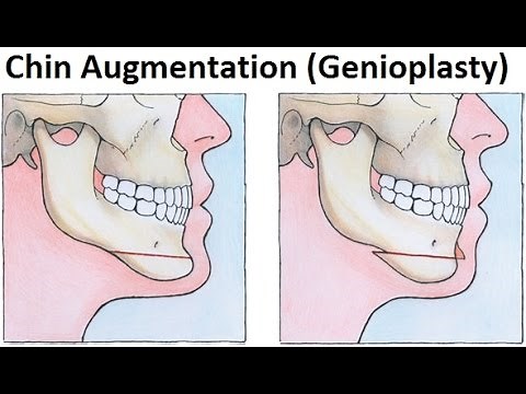 Treatment of Retruded Jaws/Mandible Using Genioplasty/Mentoplasty/Chin Augmentation by Dr Mike Mew