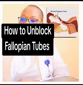Lady: Good afternoon Nurse Qwinnie. I just found out from my doctor that my fallopian tubes are blocked, and I’m really scared. I don’t fully understand what it means. Does this mean I can never get pregnant again? Is there anything I can do to fix it? Nurse Qwinnie: Good afternoon my dear. I understand how worrying this can feel, but let me break it down clearly for you. You are not alone,and yes, there is hope! Here's what you need to know: 1. What it means: Fallopian tubes are like small tunn