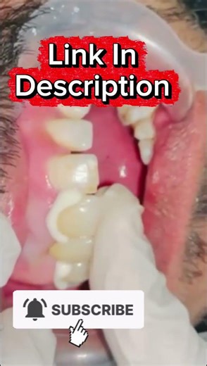 Zirconium bridge #dentist #dentistry